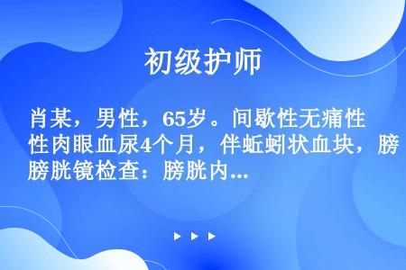 肖某，男性，65岁。间歇性无痛性肉眼血尿4个月，伴蚯蚓状血块，膀胱镜检查：膀胱内未见肿瘤，见右输尿管...