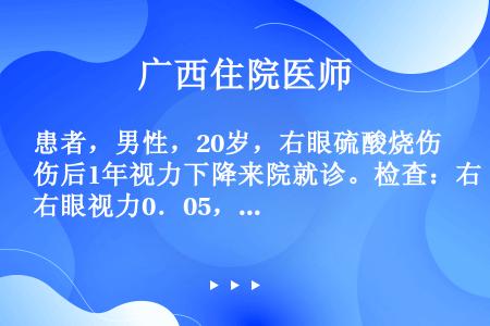 患者，男性，20岁，右眼硫酸烧伤后1年视力下降来院就诊。检查：右眼视力0．05，右眼结膜充血，角膜上...