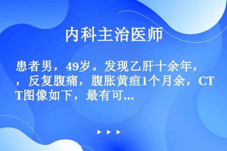 患者男，49岁。发现乙肝十余年，反复腹痛，腹胀黄疸1个月余，CT图像如下，最有可能的诊断是（）