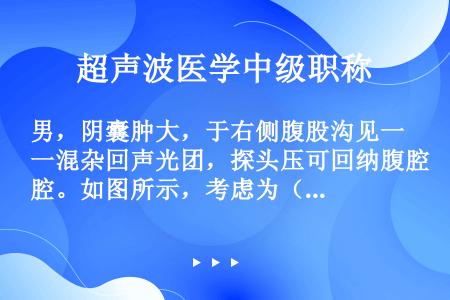 男，阴囊肿大，于右侧腹股沟见一混杂回声光团，探头压可回纳腹腔。如图所示，考虑为（　　）。