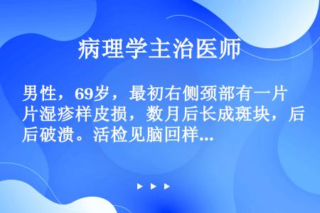 男性，69岁，最初右侧颈部有一片湿疹样皮损，数月后长成斑块，后破溃。活检见脑回样小淋巴细胞在真皮浅层...