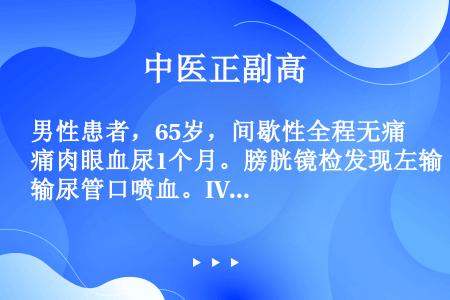 男性患者，65岁，间歇性全程无痛肉眼血尿1个月。膀胱镜检发现左输尿管口喷血。IVP示左肾盂充盈缺损。...